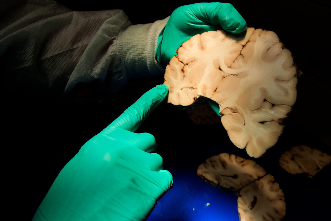 What to know about CTE, the degenerative brain disease named in NYC shooting suspect's note